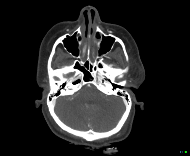 Atlanto-occipital dissociation - Traynelis type 1 (Radiopaedia 87570-103949 A 62).jpg