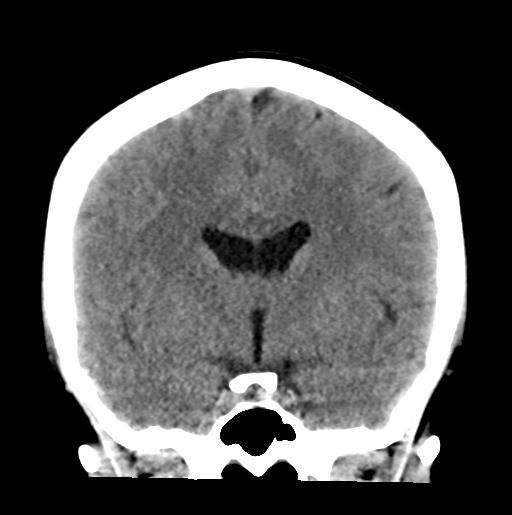 File:Atretic encephalocoele with inferior vermis hypoplasia (Radiopaedia 30443-31107 Coronal non-contrast 18).jpg