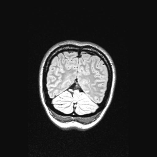 Atretic encephalocoele with inferior vermis hypoplasia (Radiopaedia 30443-31108 Coronal FLAIR 35).jpg