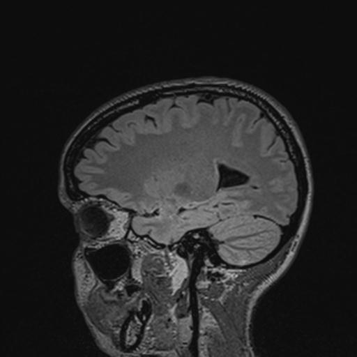 Atretic encephalocoele with inferior vermis hypoplasia (Radiopaedia 30443-31108 Sagittal FLAIR 57).jpg