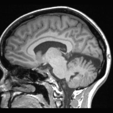 Atretic encephalocoele with inferior vermis hypoplasia (Radiopaedia 30443-31108 Sagittal T1 59).jpg