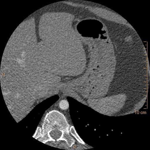 Atrial septal defect (upper sinus venosus type) with partial anomalous pulmonary venous return into superior vena cava (Radiopaedia 73228-83961 A 292).jpg
