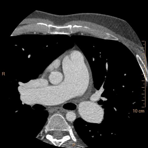 Atrial septal defect (upper sinus venosus type) with partial anomalous pulmonary venous return into superior vena cava (Radiopaedia 73228-83961 A 69).jpg