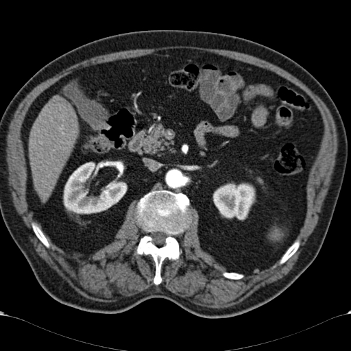 Atypical hepatocellular carcinoma (Radiopaedia 41744-44698 A 43).jpg