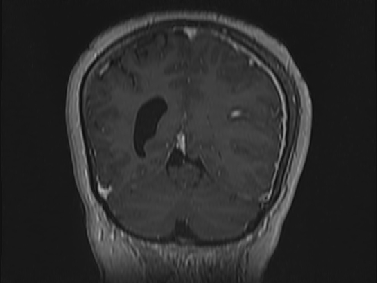 File:Atypical meningioma (Radiopaedia 62985-71406 Coronal T1 C+ 98).jpg