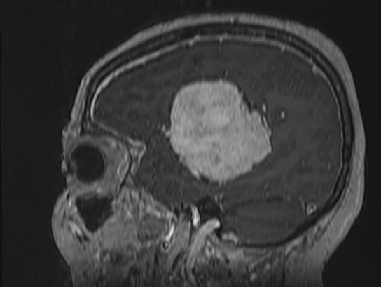 Atypical meningioma (Radiopaedia 62985-71406 Sagittal T1 C+ 72).jpg