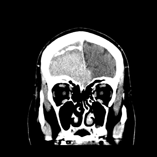 Atypical meningioma (WHO grade II) with brain invasion (Radiopaedia 57767-64728 Coronal C+ 14).png