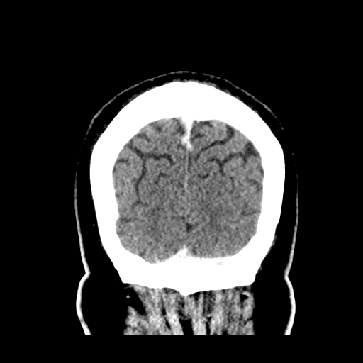 Atypical meningioma (WHO grade II) with brain invasion (Radiopaedia 57767-64728 Coronal C+ 56).png