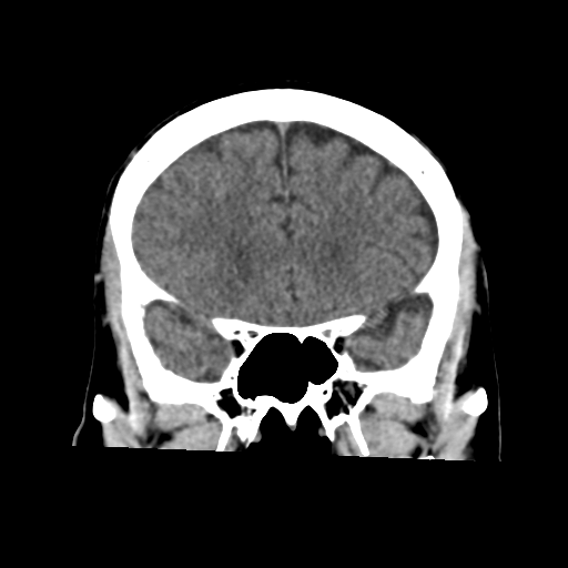 Atypical meningioma (WHO grade II) with osseous invasion (Radiopaedia 53654-59715 Coronal non-contrast 23).png