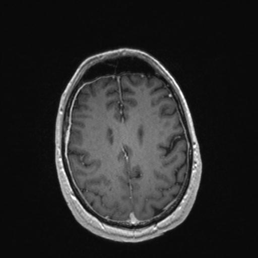 Atypical meningioma (grade II) - en plaque (Radiopaedia 29633-30147 Axial T1 C+ 134).jpg
