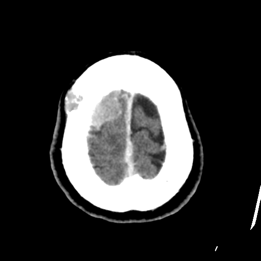 Atypical meningioma with skull invasion (Radiopaedia 34357-35649 Axial C+ delayed 47).png