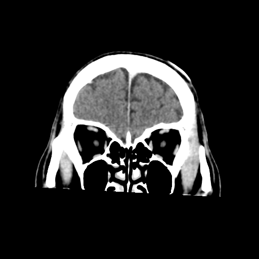 Atypical meningioma with skull invasion (Radiopaedia 34357-35649 Coronal C+ delayed 13).png