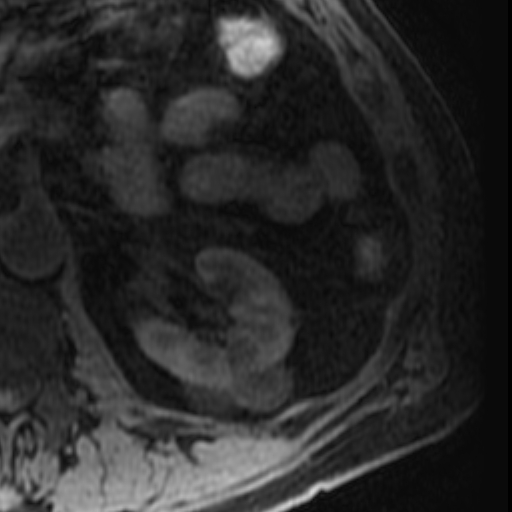 File:Atypical renal cyst on MRI (Radiopaedia 17349-17046 Axial T1 fat sat 14).jpg