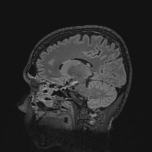 File:Autoimmune limbic encephalitis (Radiopaedia 30363-31005 Sagittal FLAIR 93).jpg