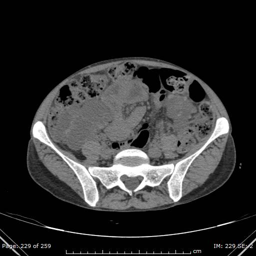 Autosomal dominant polycystic kidney disease (Radiopaedia 44122-47684 Axial non-contrast 82).jpg