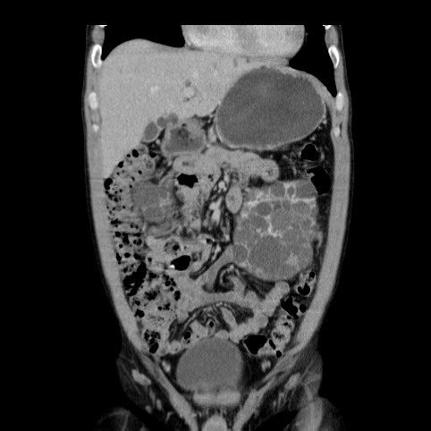Autosomal dominant polycystic kidney disease (Radiopaedia 66349-75582 A 17).jpg