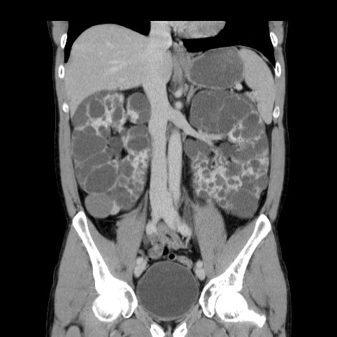 Autosomal dominant polycystic kidney disease (Radiopaedia 66349-75582 A 41).jpg