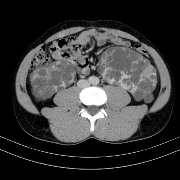 Autosomal dominant polycystic kidney disease (Radiopaedia 66349-75582 B 61).jpg