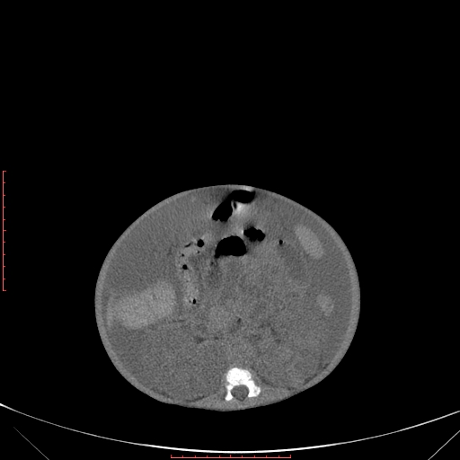 Autosomal recessive polycystic kidney disease associated with Caroli disease (Radiopaedia 61932-69984 Axial non-contrast 212).jpg