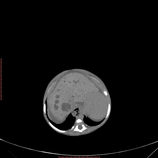 File:Autosomal recessive polycystic kidney disease associated with Caroli disease (Radiopaedia 61932-69984 B 109).jpg