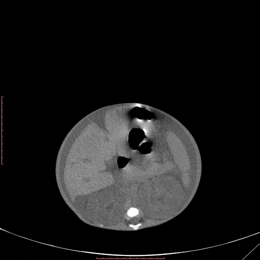 Autosomal recessive polycystic kidney disease associated with Caroli disease (Radiopaedia 61932-69984 B 182).jpg