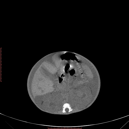 Autosomal recessive polycystic kidney disease associated with Caroli disease (Radiopaedia 61932-69984 B 192).jpg