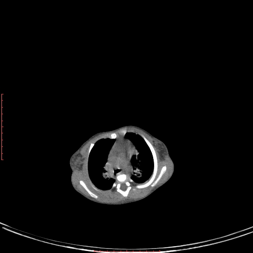 Autosomal recessive polycystic kidney disease associated with Caroli disease (Radiopaedia 61932-69984 B 38).jpg