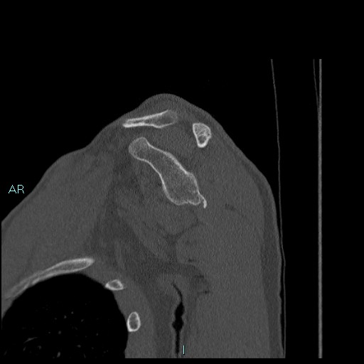 Avascular necrosis after fracture dislocations of the proximal humerus (Radiopaedia 88078-104655 Sagittal bone window 34).jpg