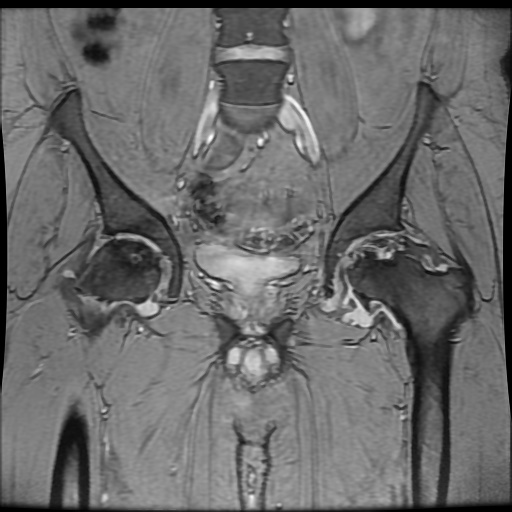 Avascular necrosis of the hip (Radiopaedia 61503-69465 F 40).jpg