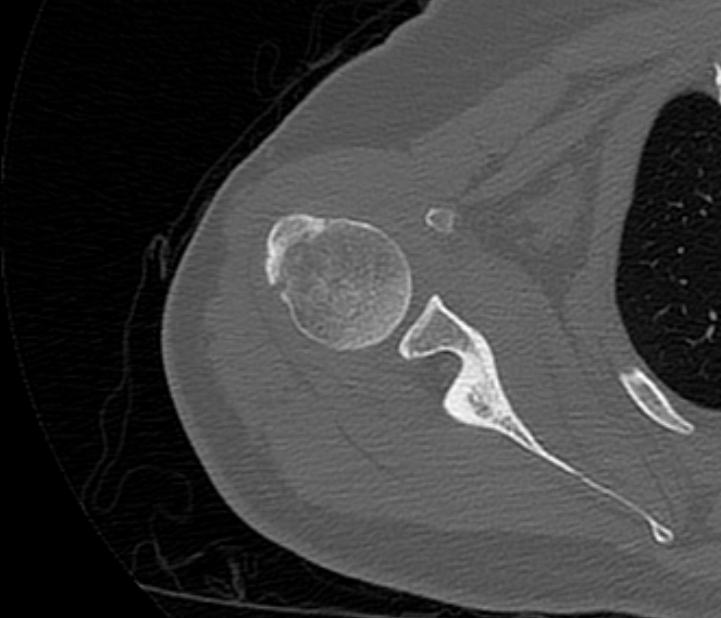 Avulsion fracture - greater tuberosity of humerus (Radiopaedia 71216-81514 Axial bone window 33).jpg