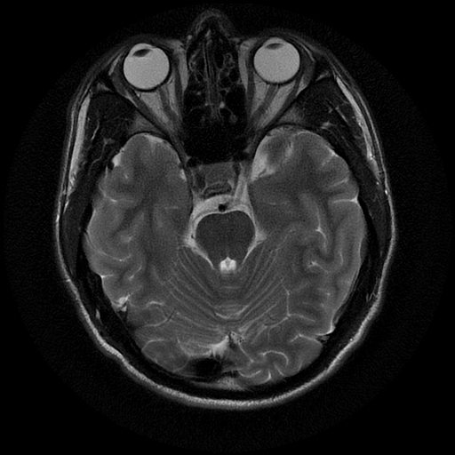 File:Azygos anterior cerebral artery (Radiopaedia 17059-16756 Axial T2 17).jpg