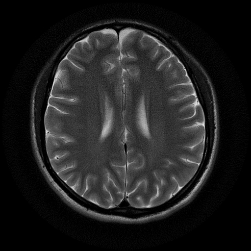 File:Azygos anterior cerebral artery (Radiopaedia 17059-16756 Axial T2 9).jpg