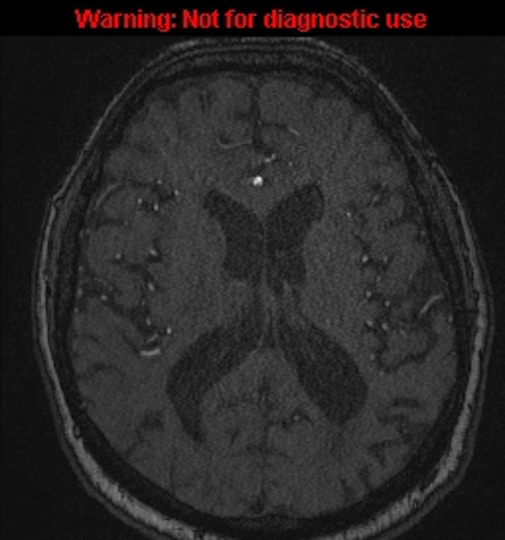 Azygos anterior cerebral artery (Radiopaedia 59325-66677 Axial MRA 102).jpg