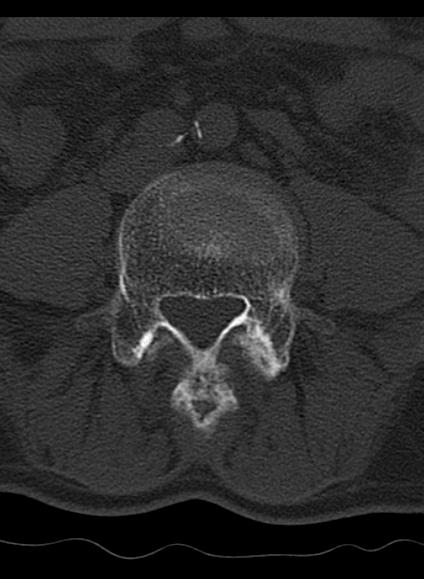 File:Baastrup syndrome (Radiopaedia 64891-73838 Axial bone window 6).jpg