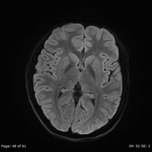 Balo concentric sclerosis (Radiopaedia 61637-69636 Axial DWI 48).jpg
