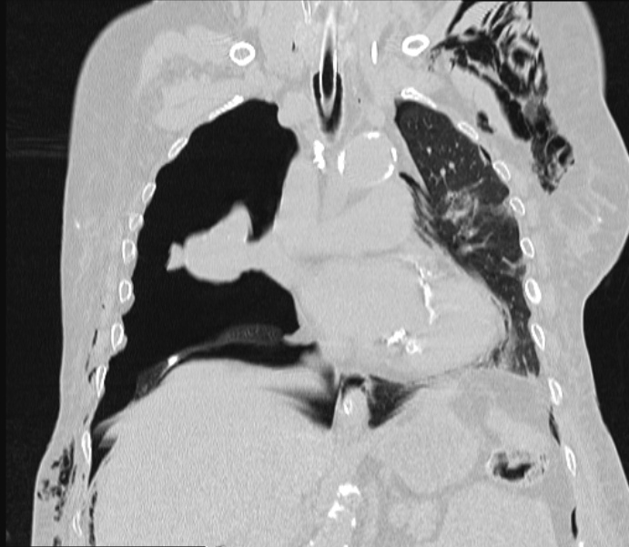 Barotrauma due to mechanical ventilation (Radiopaedia 28079-28336 Coronal lung window 48).jpg
