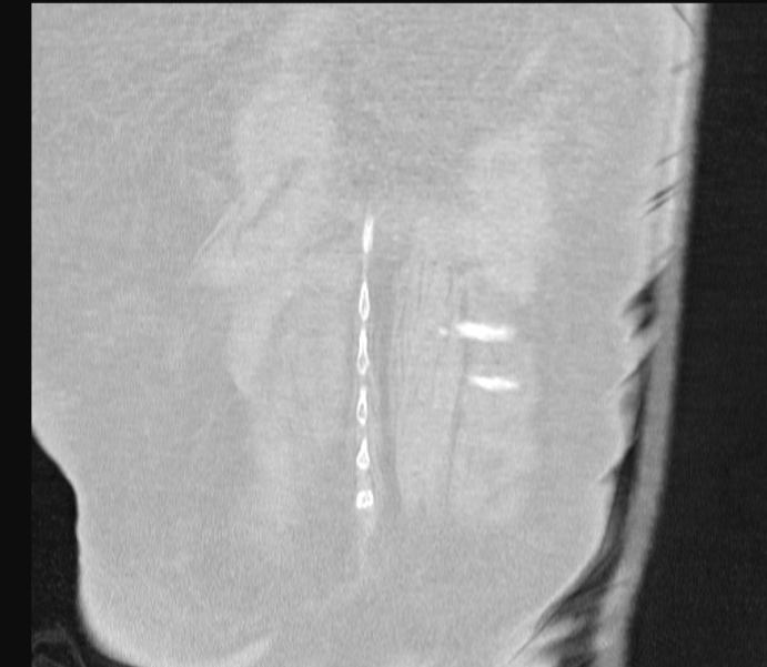 Barotrauma due to mechanical ventilation (Radiopaedia 28079-28336 Coronal lung window 86).jpg