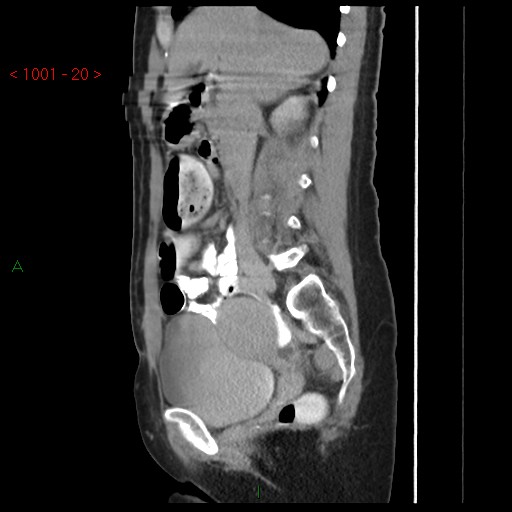 File:Bartholin gland cyst (Radiopaedia 54904-61181 Sagittal C+ delayed 20).jpg