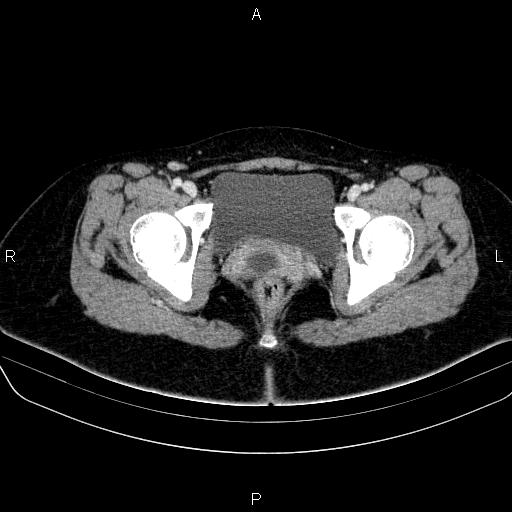 File:Bartholin gland cyst (Radiopaedia 62635-70930 Axial Post contrast 69).jpg