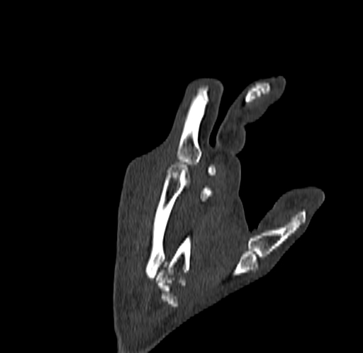 Base of 2nd metacarpal fracture (Radiopaedia 73741-84544 Coronal bone window 66).jpg
