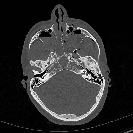 Base of skull fracture with bilateral Le Fort fractures (Radiopaedia 47094-51638 Axial bone window 29).jpg