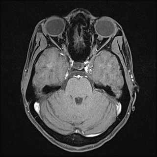 File:Basilar artery perforator aneurysm (Radiopaedia 82455-97733 Axial T1 fat sat 50).jpg