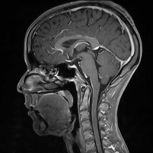 Basilar artery perforator aneurysm (Radiopaedia 82455-97733 G 77).jpg