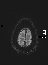 Basilar artery perforator aneurysm (Radiopaedia 82455-99523 Axial SWI 64).jpg