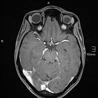 File:Basilar artery perforator aneurysm (Radiopaedia 82455-99523 G 53).jpg