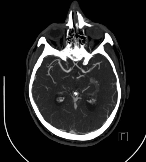 Basilar artery thrombosis (Radiopaedia 26986-27163 A 43).jpg