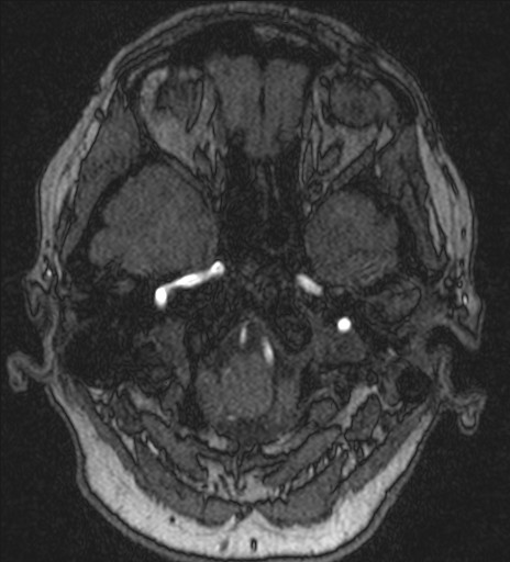 Basilar tip aneurysm (Radiopaedia 26504-26632 MRA 32).jpg