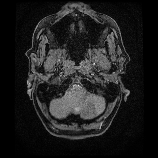 Basilar top and left middle cerebral artery aneurysm (Radiopaedia 61965-70031 Axial MRA 2).jpg