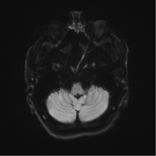 File:Behavioral variant frontotemporal dementia and late onset schizophrenia (Radiopaedia 52197-58083 Axial DTI Trace W 32).png