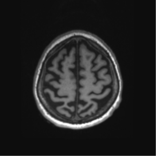 Behavioral variant frontotemporal dementia and late onset schizophrenia (Radiopaedia 52197-58083 Axial T1 9).png